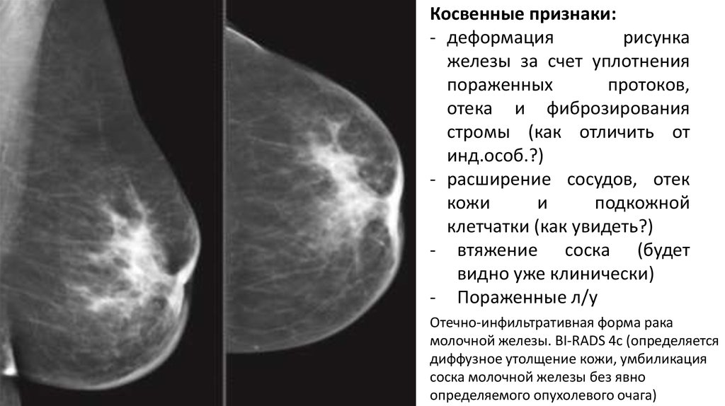 Как проверить грудные железы самостоятельно на уплотнение фото признаки