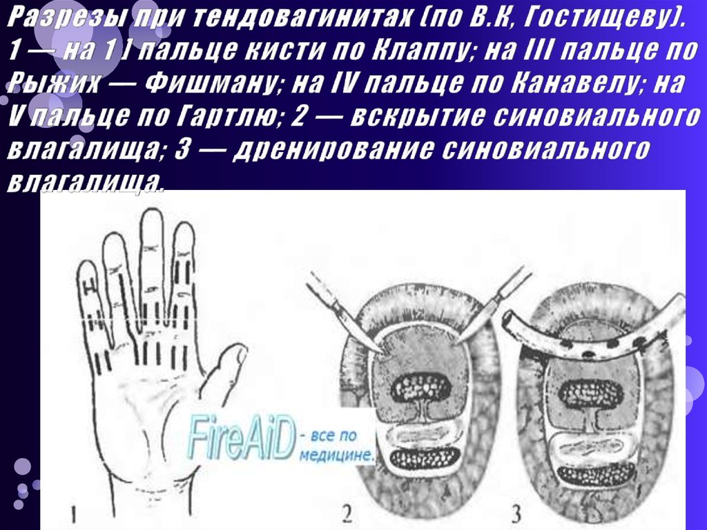 Разрезы при тендовагинитах (по В.К, Гостищеву). 1 — на 1 ] пальце кисти по Клаппу; на III пальце по Рыжих — Фишману; на IV
