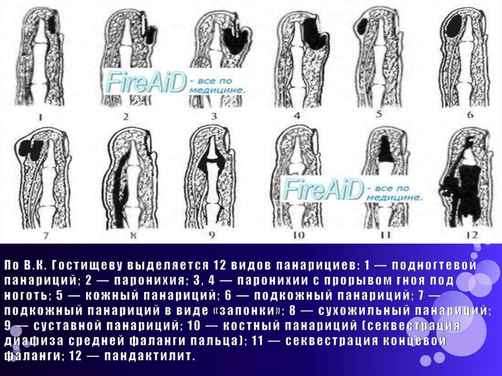 По В.К. Гостищеву выделяется 12 видов панарициев: 1 — подногтевой панариций; 2 — паронихия; 3, 4 — паронихии с прорывом гноя
