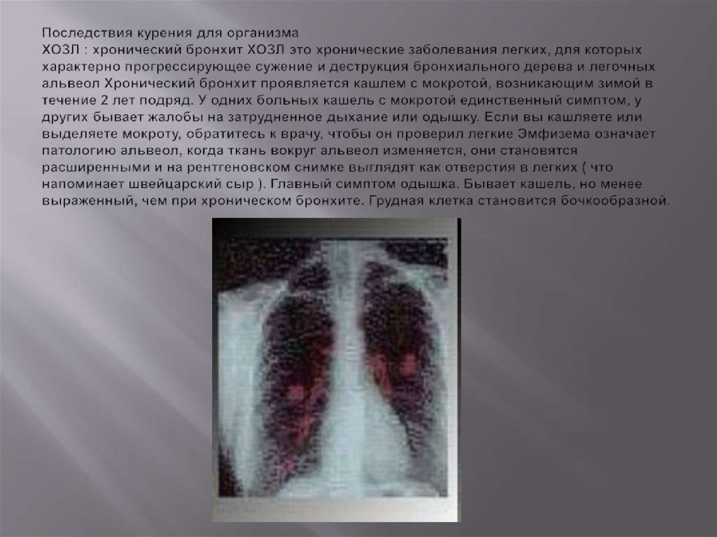 Последствия курения для организма ХОЗЛ : хронический бронхит ХОЗЛ это хронические заболевания легких, для которых характерно