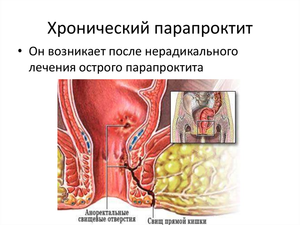 Клиническая картина парапроктита