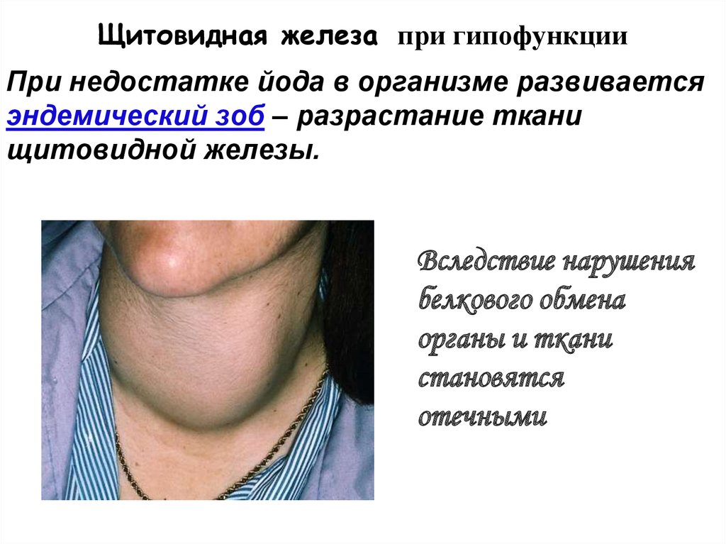 Увеличенная Щитовидная Железа И Лишний Вес