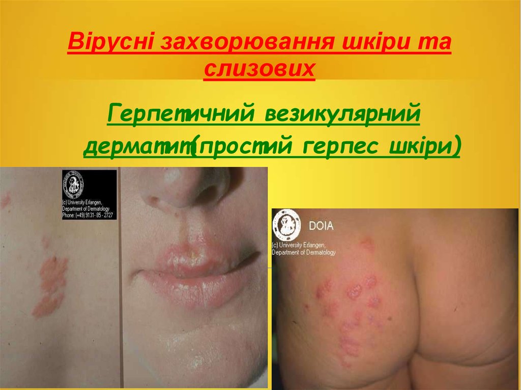 Вірусні захворювання шкіри та слизових