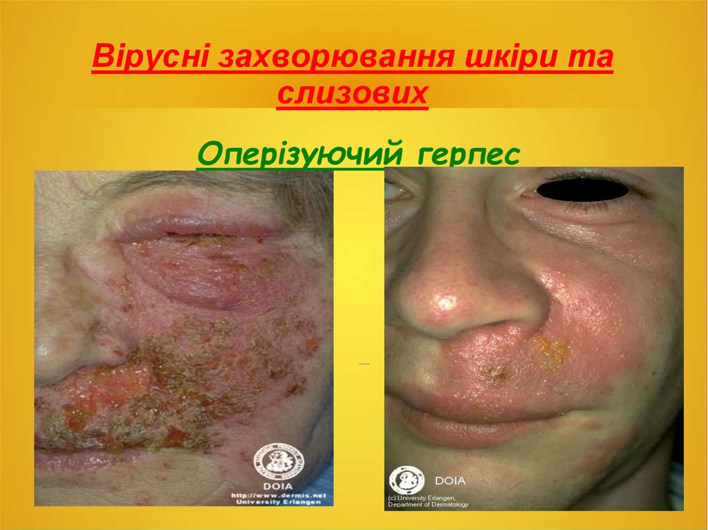 Вірусні захворювання шкіри та слизових