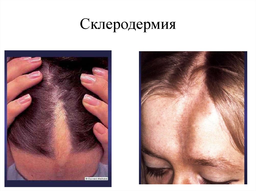 Диета При Псориазе Волосистой Части Головы