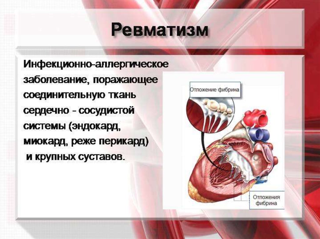 Ревматическая болезнь сердца презентация