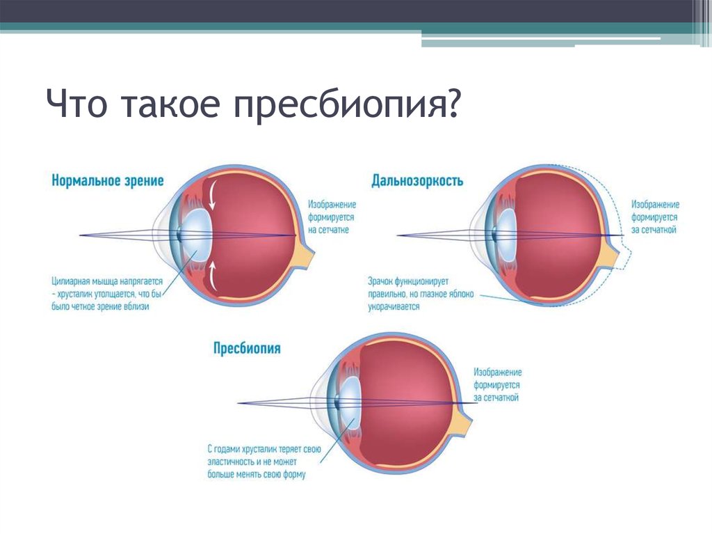 Хрусталик фокусирует изображение на сетчатку