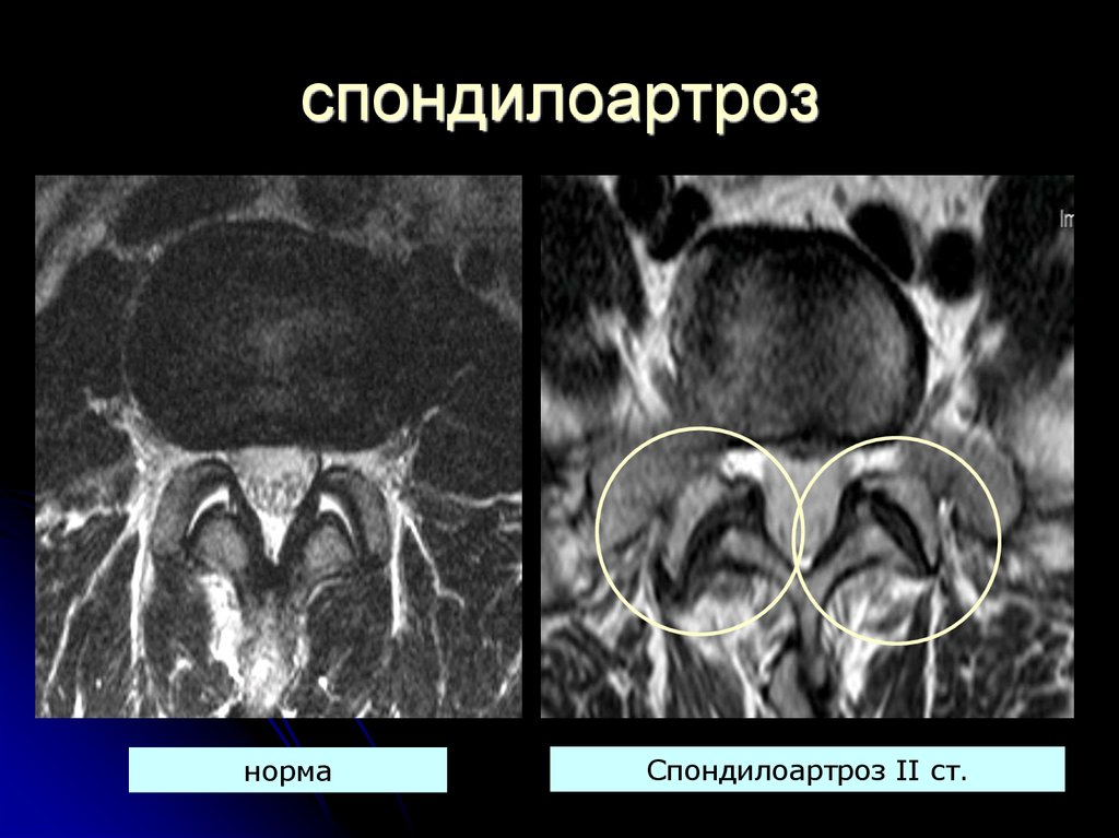 Фасеточные суставы позвоночника картинки