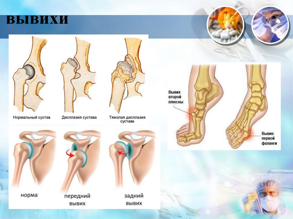 Картинка вывиха сустава