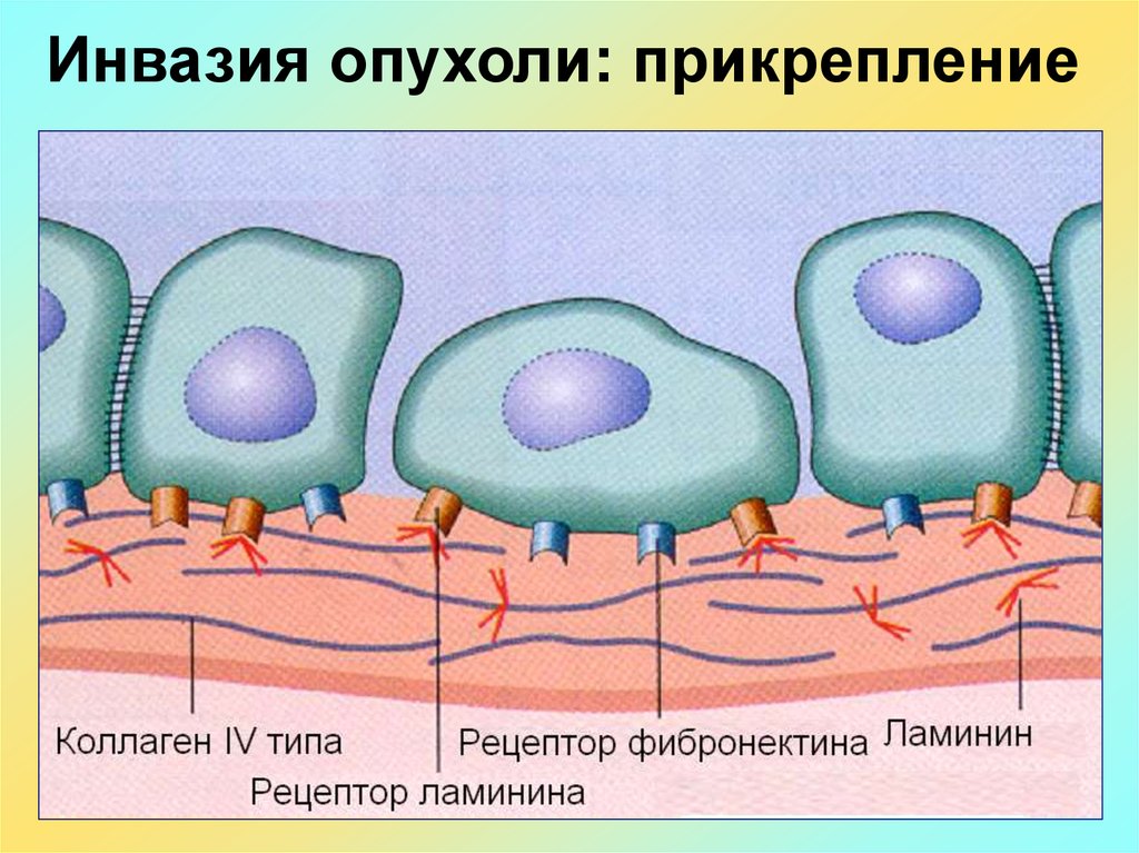 Инвазивный рост опухоли рисунок