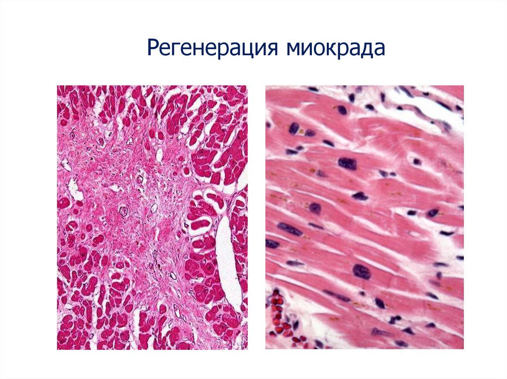 Регенерация тканей. Репаративная регенерация мышечной ткани. Регенерация сердечной ткани гистология. Регенерация миокарда патанатомия. Регенерация мышечной ткани гистология.