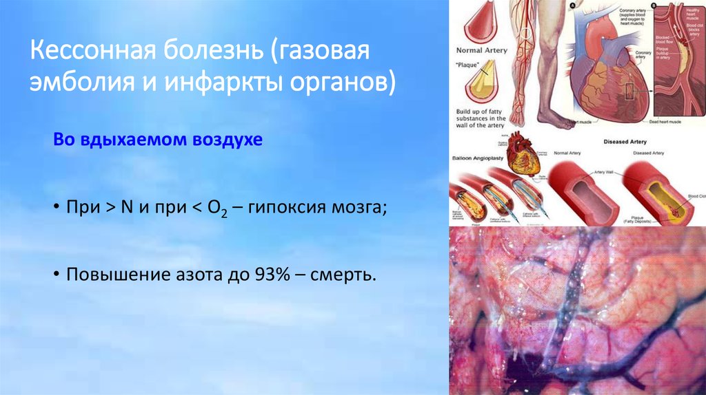 Кессонная болезнь (газовая эмболия и инфаркты органов)