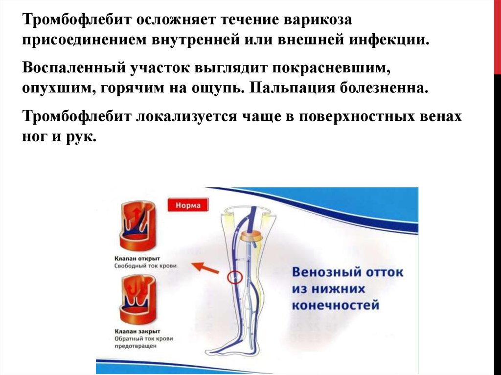 Тромбоз артерии мкб 10. Артериальные и венозные тромбозы диагностика. Заболевание периферических артерий и вен.