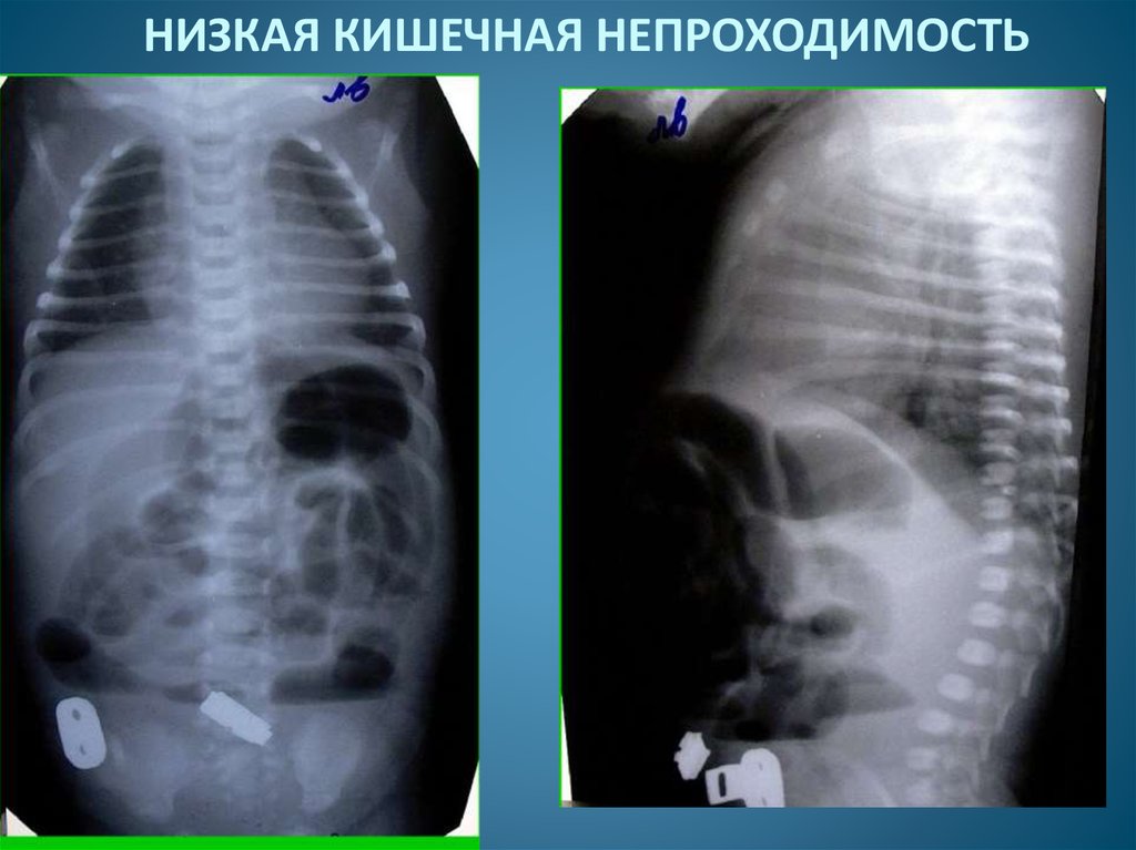 Врожденная кишечная. Тонкокишечная непроходимость рентген. Врожденная высокая кишечная непроходимость рентген. Врожденная кишечная непроходимость рентген. Врожденная низкая кишечная непроходимость рентген.