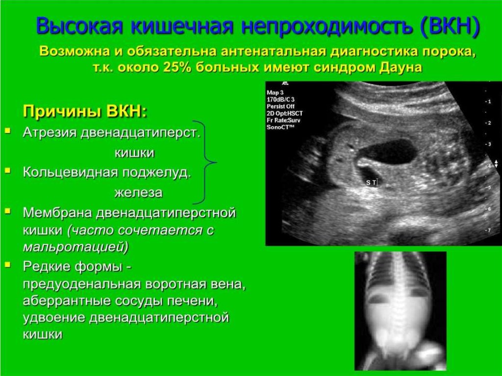 Врожденная высокая кишечная непроходимость. Высокая кишечная непроходимость. Врожденная кишечная непроходимость. Антенальная диагностика врождённой кишечной непроходимости. Врожденная кишечная непроходимость дифференциальная диагностика.