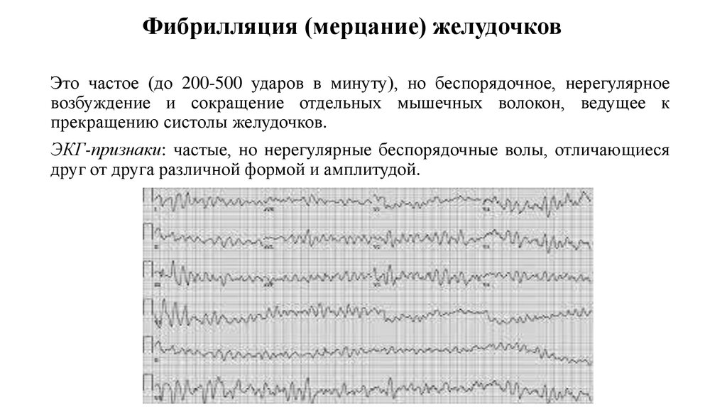 Фибрилляция это. Мерцание и фибрилляция. Мерцание желудочков на ЭКГ признаки. Мерцание желудочковая патогенез.