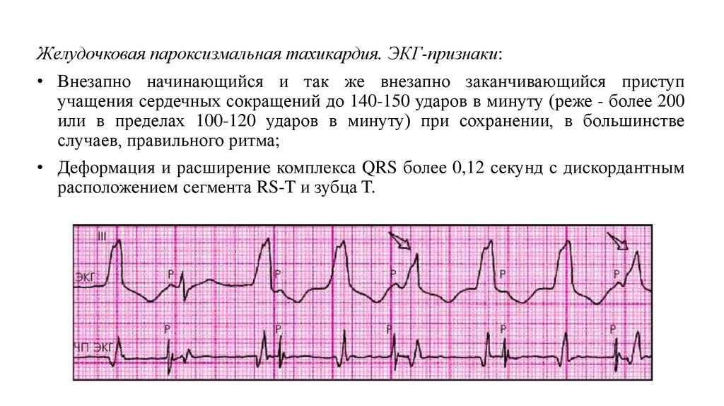 Экстрасистолия карта вызова