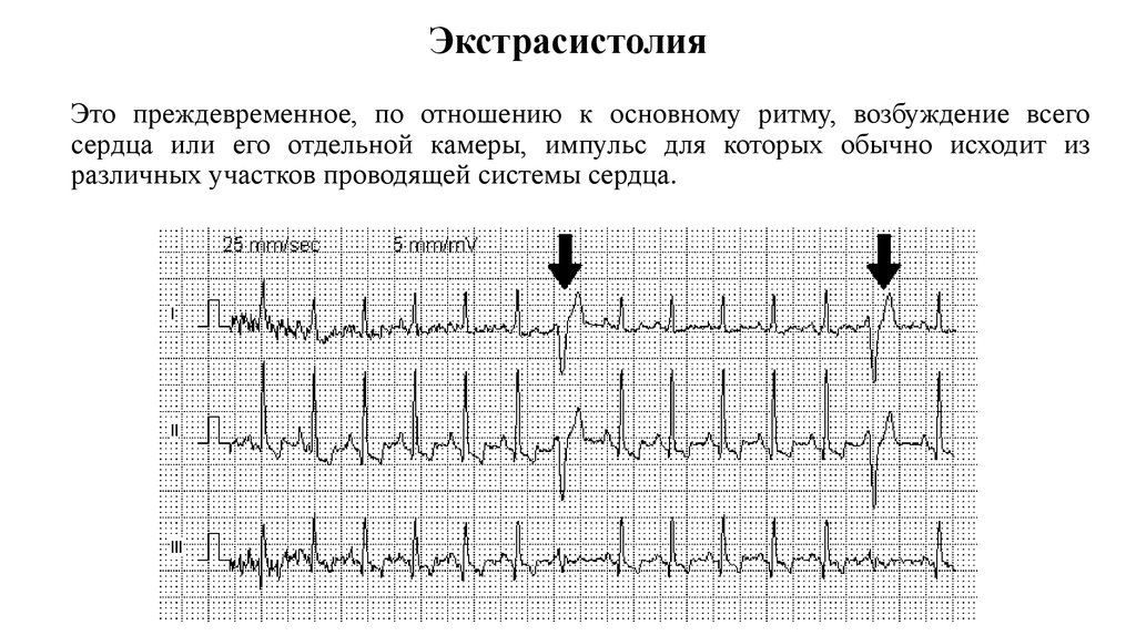 Экстрасистолия сердца что это. Ритм при экстрасистолии. Экстрасистолия аритмия клиника. Экстрасистолия жалобы. Экстрасистолия клиника.