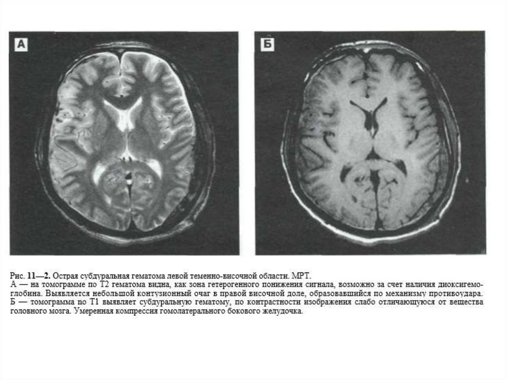 Мр признаки расширения субарахноидального пространства. Субдуральное кровоизлияние мрт. Субдуральная и субарахноидальная гематома. Субдуральное кровоизлияние головного мозга мрт. Субарахноидальное кровоизлияние мрт.