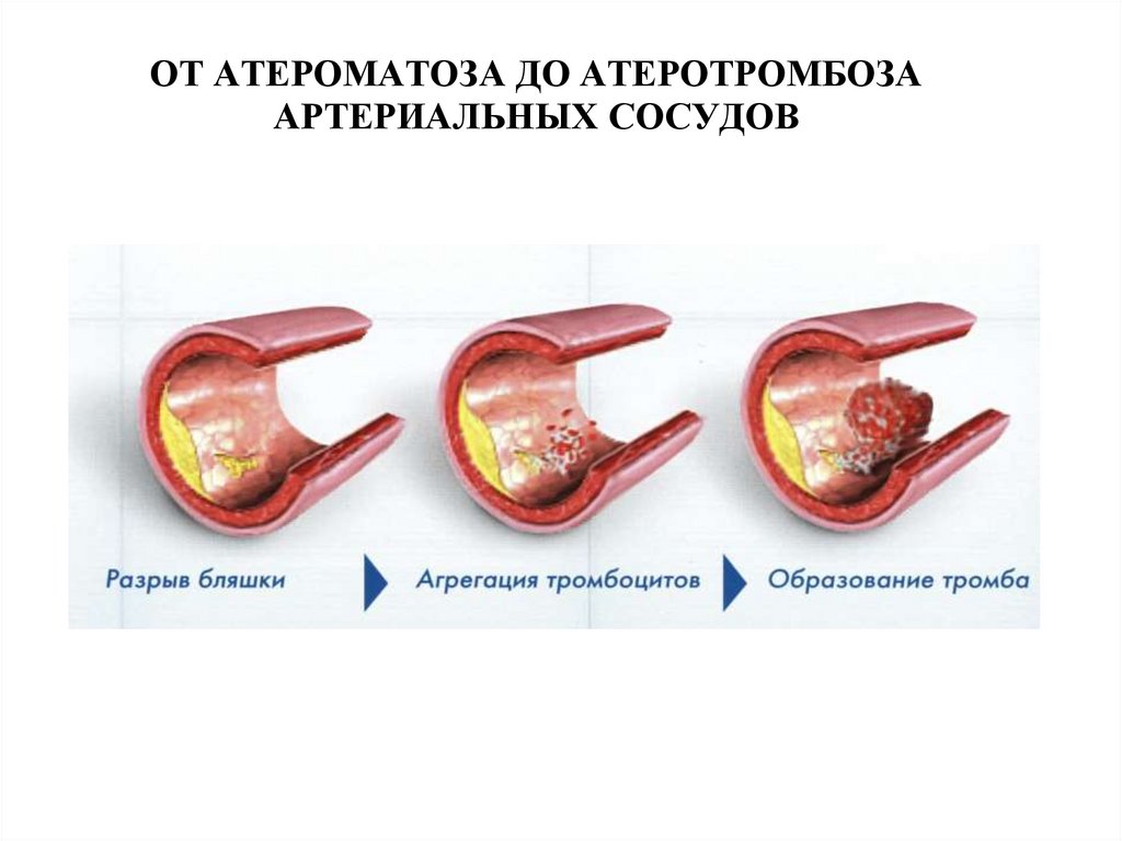 Разрыв бляшки. Механизм атеротромбоза. От атероматоза до атеротромбоза артериальных сосудов.