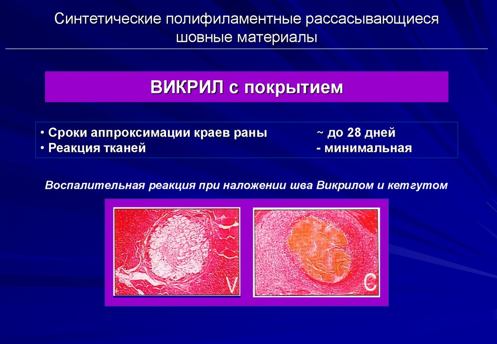 Реакция в тканях. Синтетические рассасывающиеся шовные материалы. Полифиламентный шовный материал. Сроки рассасывания шовного материала. Современный рассасывающийся материал.