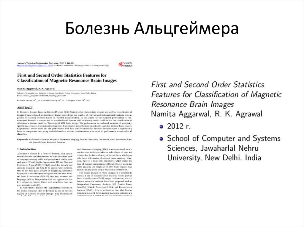 Болезнь Альцгеймера