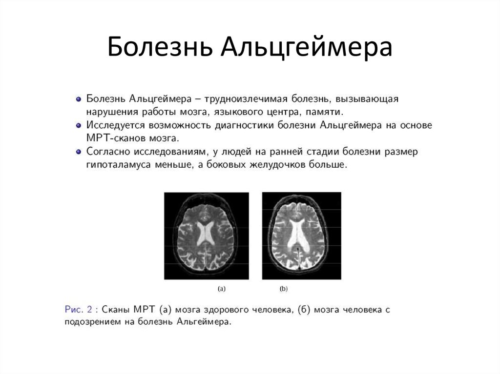 Атрофия головного мозга продолжительность. Кт и мрт при болезни Альцгеймера. Болезнь Альцгеймера на кт. Мрт головного мозга болезнь Альцгеймера. Мрт головного мозга при болезни Альцгеймера.