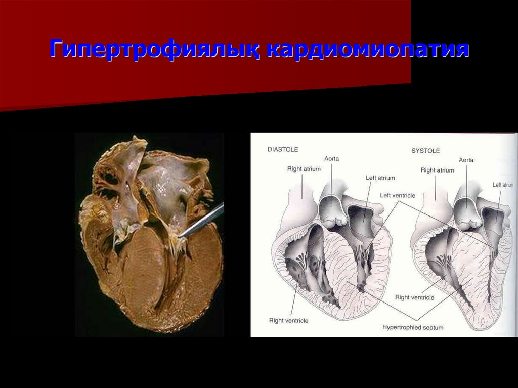 Гипертрофиялық кардиомиопатия