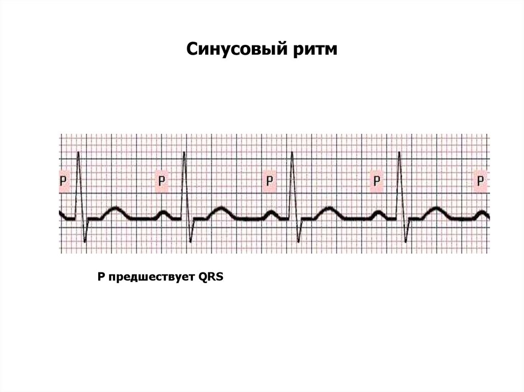 Что значит синусовый ритм сердца на экг. Правильный синусовый ритм на ЭКГ. Электрокардиограмма показатели синусовый ритм. ЭКГ нормальные синусовый ритм норма. Кардиограмма сердца синусовый ритм норма.