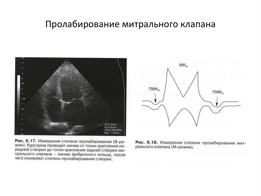 Недостаточность створок митрального клапана