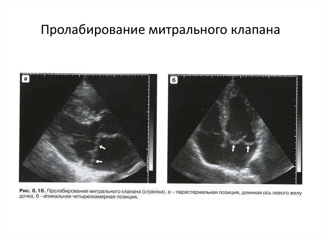 Пролапс митрального клапана картинка