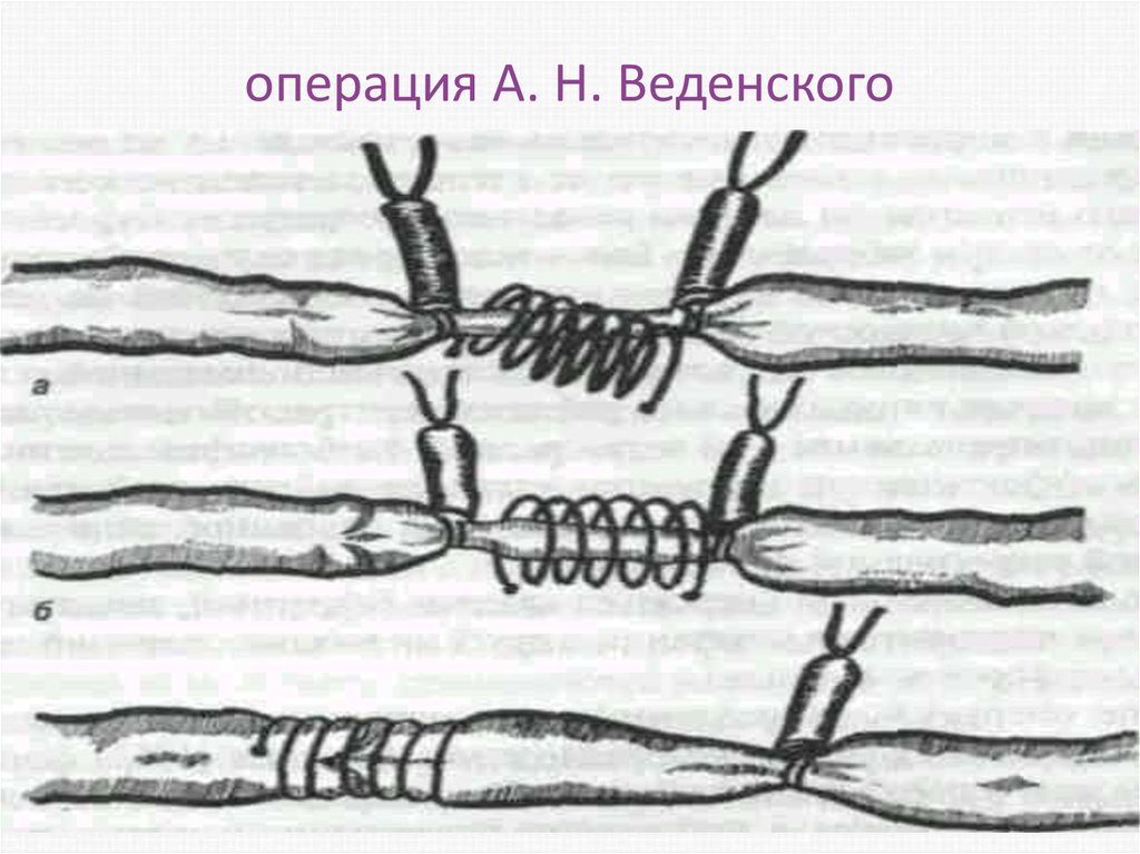 Четыре операции. Операция по Веденскому. Экстравазальные вмешательство. Экстравазальная пластика. По Веденскому операция Сутт.