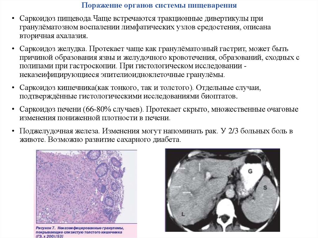 Саркоидоз фтизиатрия презентация