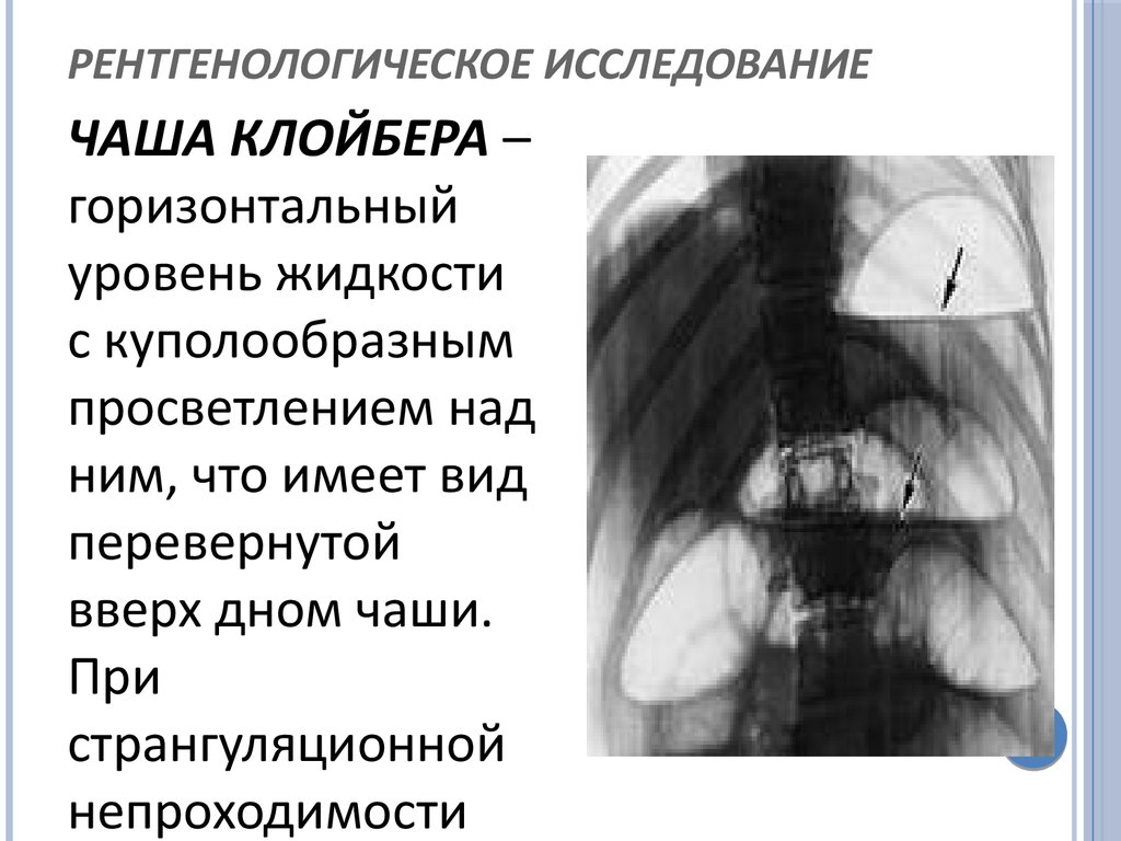 Горизонтальные уровни жидкости. Рентген брюшной полости чаши Клойбера. Кишечная непроходимость чаши Клойбера.