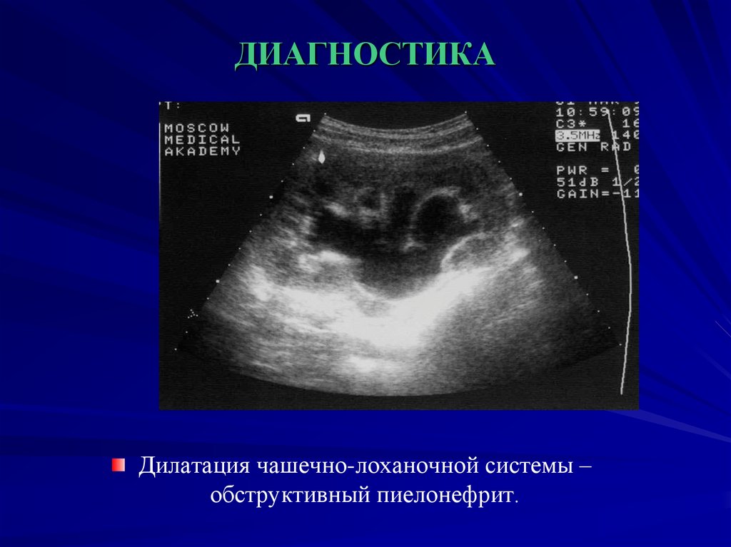 Члс почек. Дилатация чашечно-лоханочной системы. Чашечно лоханочная система диагностика. Заболевания чашечно-лоханочной системы. Дилатация ЧЛС почек.