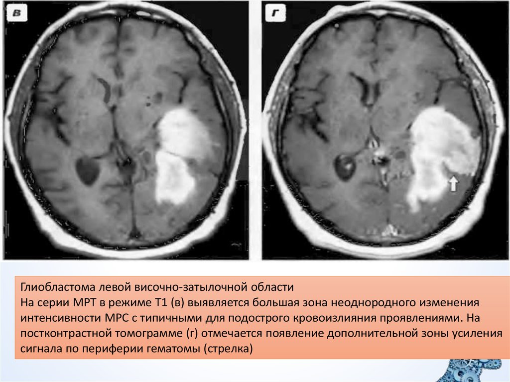 Глиобластома мозга симптомы. Опухоль головного мозга глиобластома 4. Глиобластома головного мозга на кт. Глиобластома головного мозга на кт и мрт. Глиобластома головного мозга 1 степень.