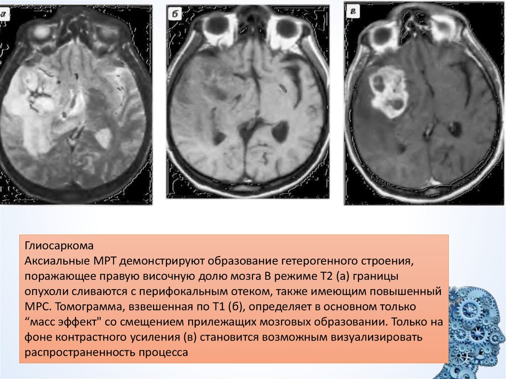 Рак головного мозга презентация