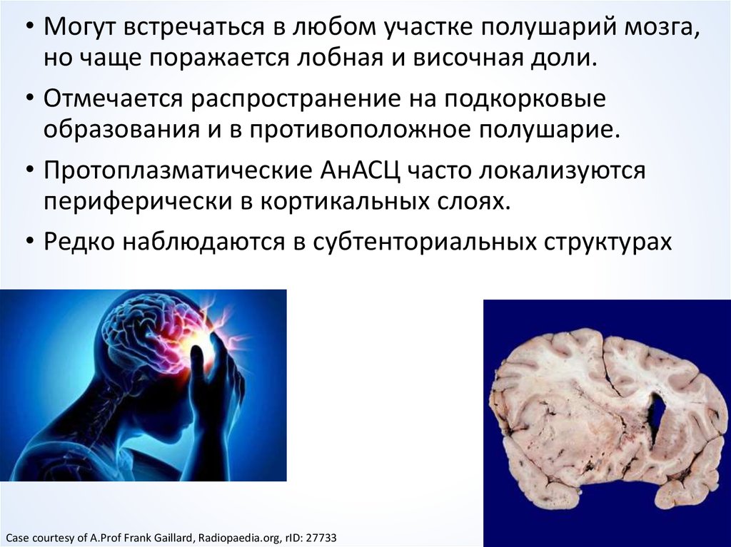 Опухоли мозга статистика. Опухоли головного мозга презентация. Презентация опухоль мозга. Злокачественная опухоль головного мозга симптомы. Опухоль головного мозга симптомы.