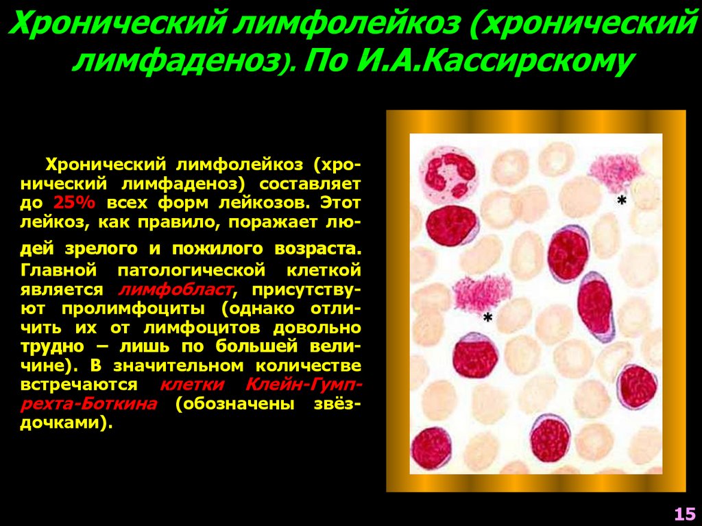 Хронический лимфолейкоз. Лимфатические узлы при хроническом лимфоцитарном лейкозе. Хронический лимфоцитарный лейкоз. Хронические лимфоидные лейкозы. Хронический лимфобластный лейкоз (ХЛЛ).