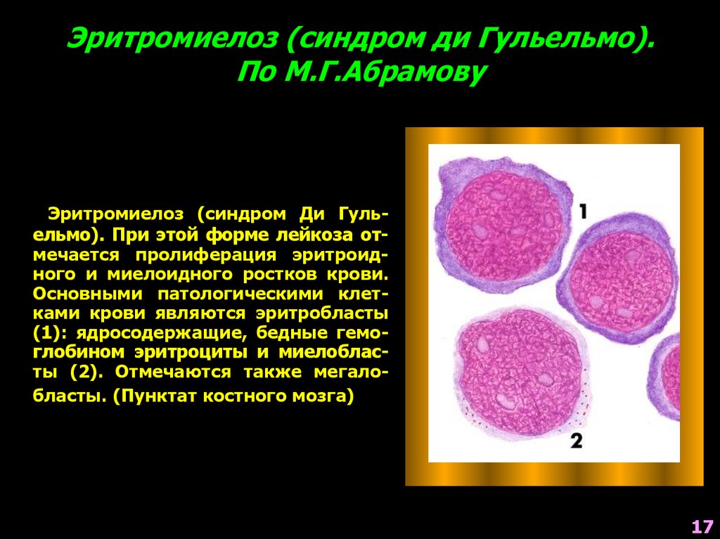 Эритромиелоз картина крови