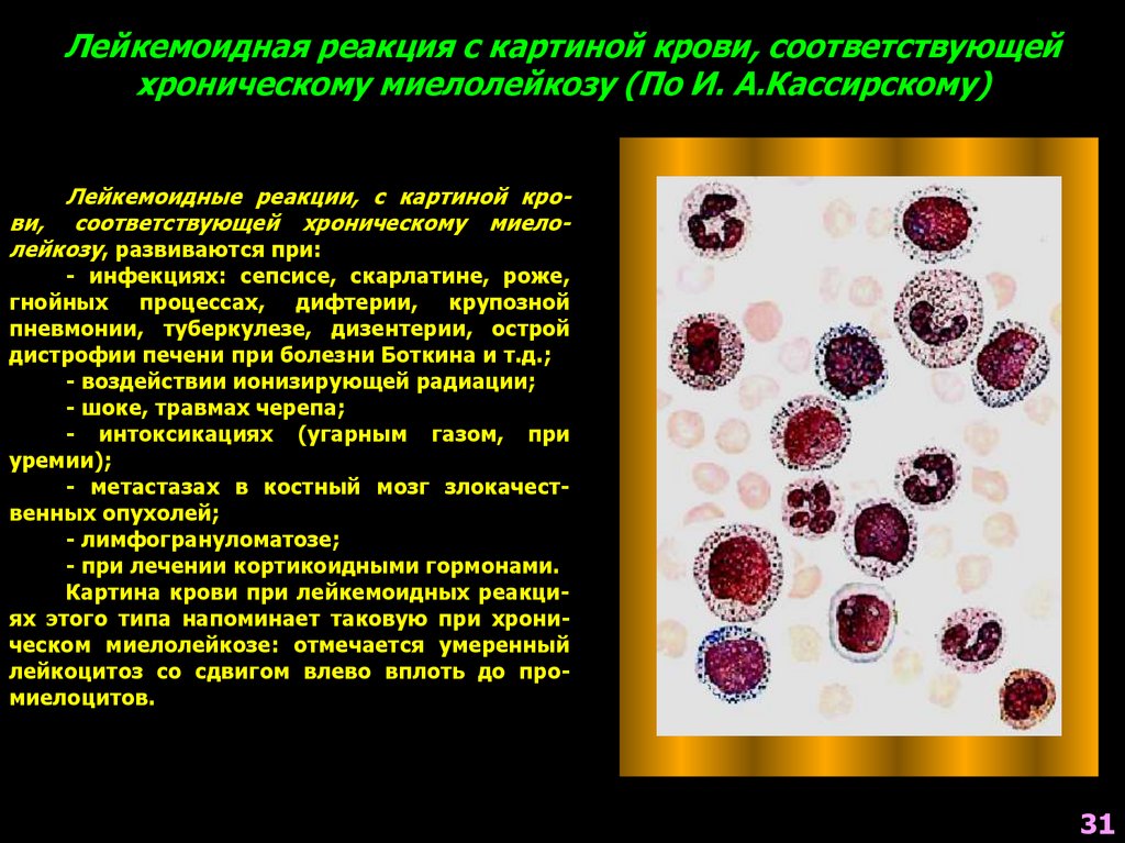 Хронический миелолейкоз у детей презентация