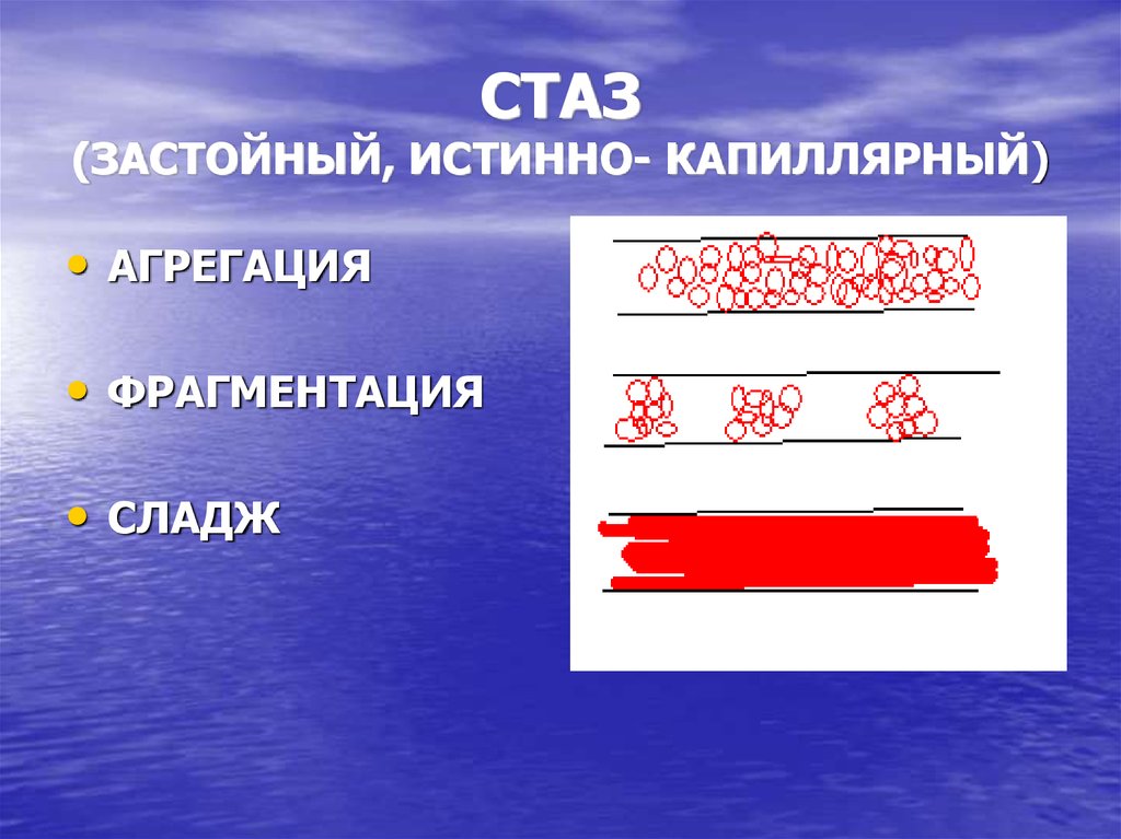 Стаз это