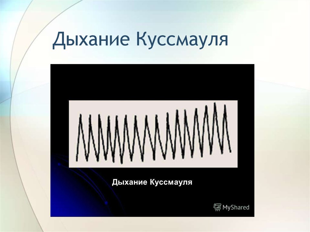 Типы дыхания рисунок. Патологические типы дыхания Куссмауля. Ацидотическое дыхание Куссмауля. Механизм возникновения дыхания Куссмауля. Дыхание Куссмауля график.