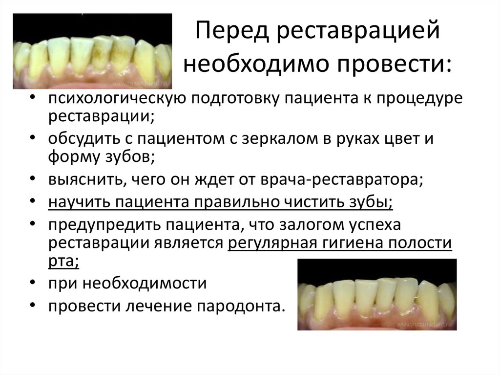 Перед реставрацией. Принципы реставрации зубов. Сохранение зубов презентация. Реставрация передней группы зубов. Материалы. Реставрация зубов схема.