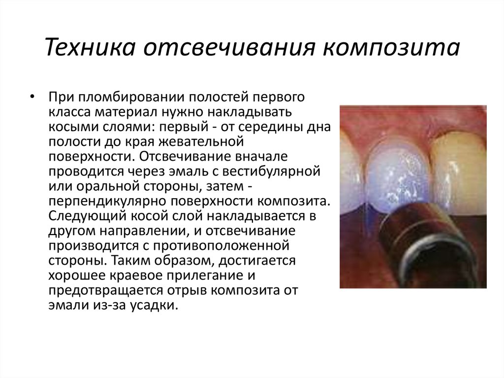 Материалы для пломбирования кариозных полостей. Пломбирование кариозной полости композитом светового отверждения. Этапы пломбирования композитами светового отверждения. Техники пломбирования композитными материалами. Методика постановки пломбы из композита светового отверждения.