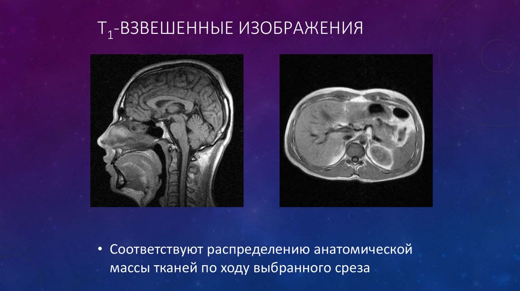 Т1 и т2 взвешенные изображения в мрт отличия