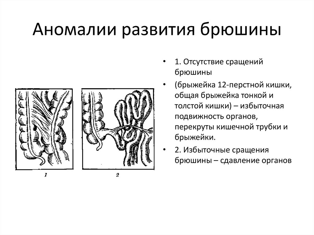 Аномалии развития. Аномалии развития органов пищеварительной системы. Аномалии развития пищевар системы. Аномалии развития брюшины. Пороки развития брюшины.