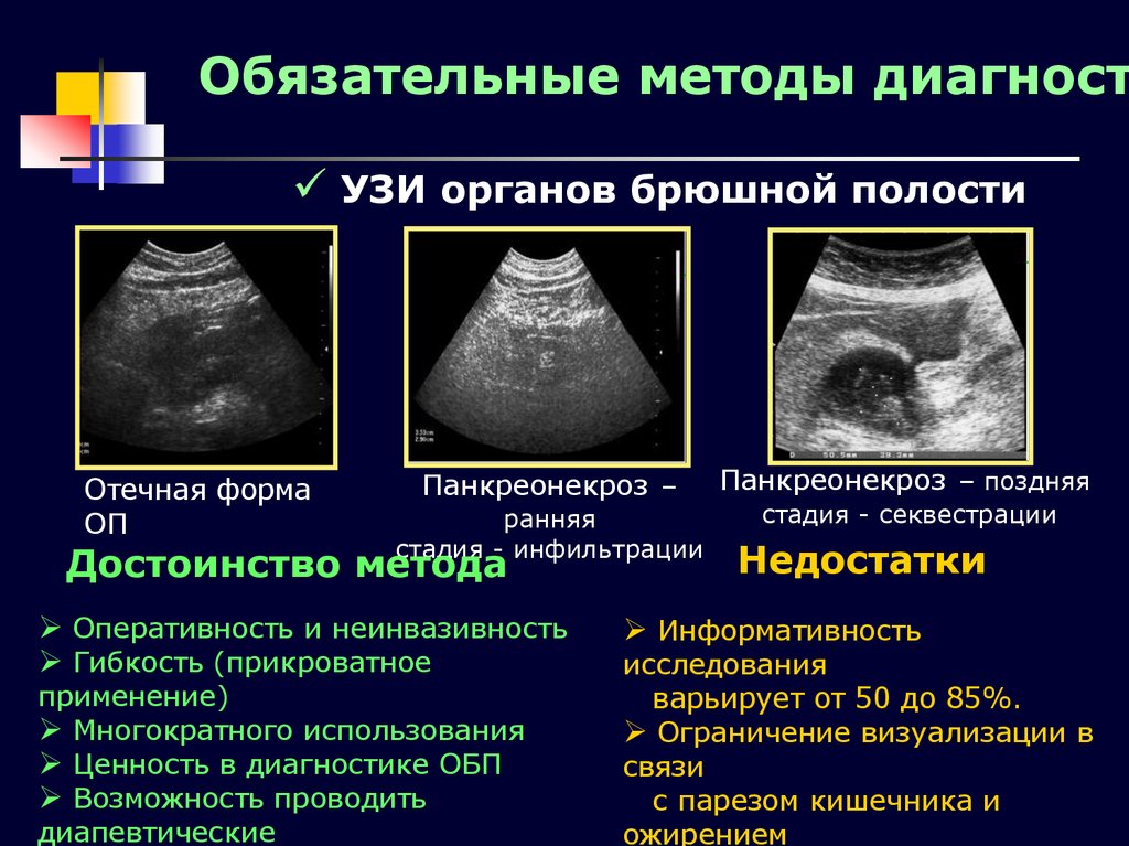 Отечный панкреатит