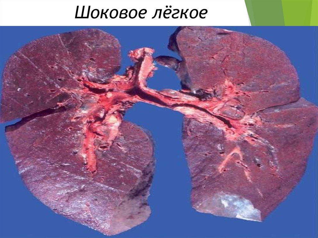Шоковое лёгкое