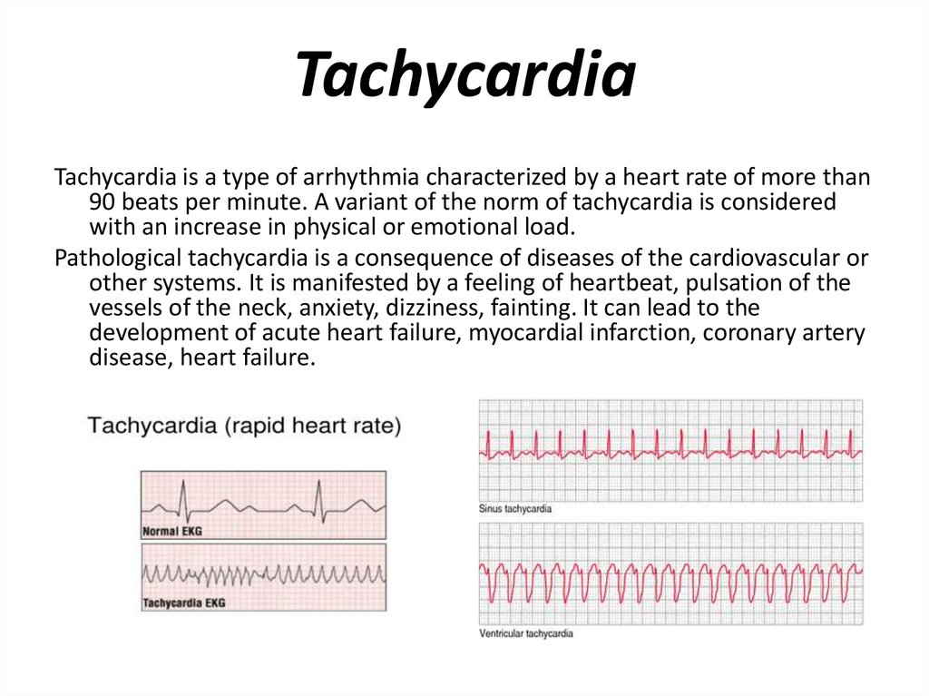 tachycardia-online-presentation